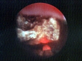 bobrek-tasi-kumu-5