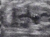 prenatal-hidronefroz-derece-1