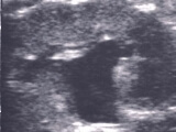 prenatal-hidronefroz-derece-2