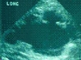 prenatal-hidronefroz-derece-3