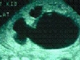 prenatal-hidronefroz-derece-4