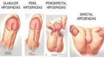 Hipospadias