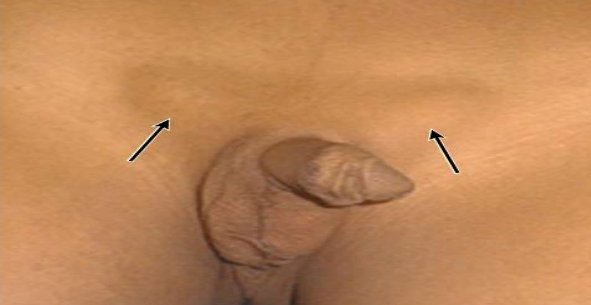 bebeklerde inmemiş çift testis