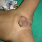 inmemiş testis görünümü