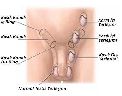 inmemiş testis