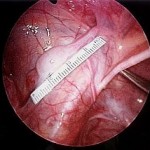 karın içerisindeki inmemiş testis