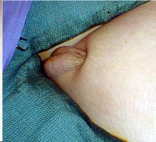 kısa penis
