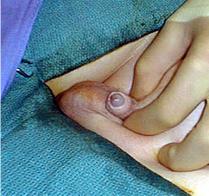 kısa penis