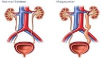 Megaüreter / Üreterosel