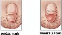 Sünnet ve Sünnet Hataları