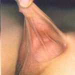 sünnet sonrası oluşan gömük penis