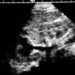 ultrasonda sol çift böbrekte üreterosel